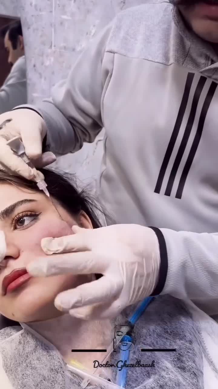 سابسیژن جای جوش؛ آزادسازی چسبندگی فیبروتیک زیر پوست