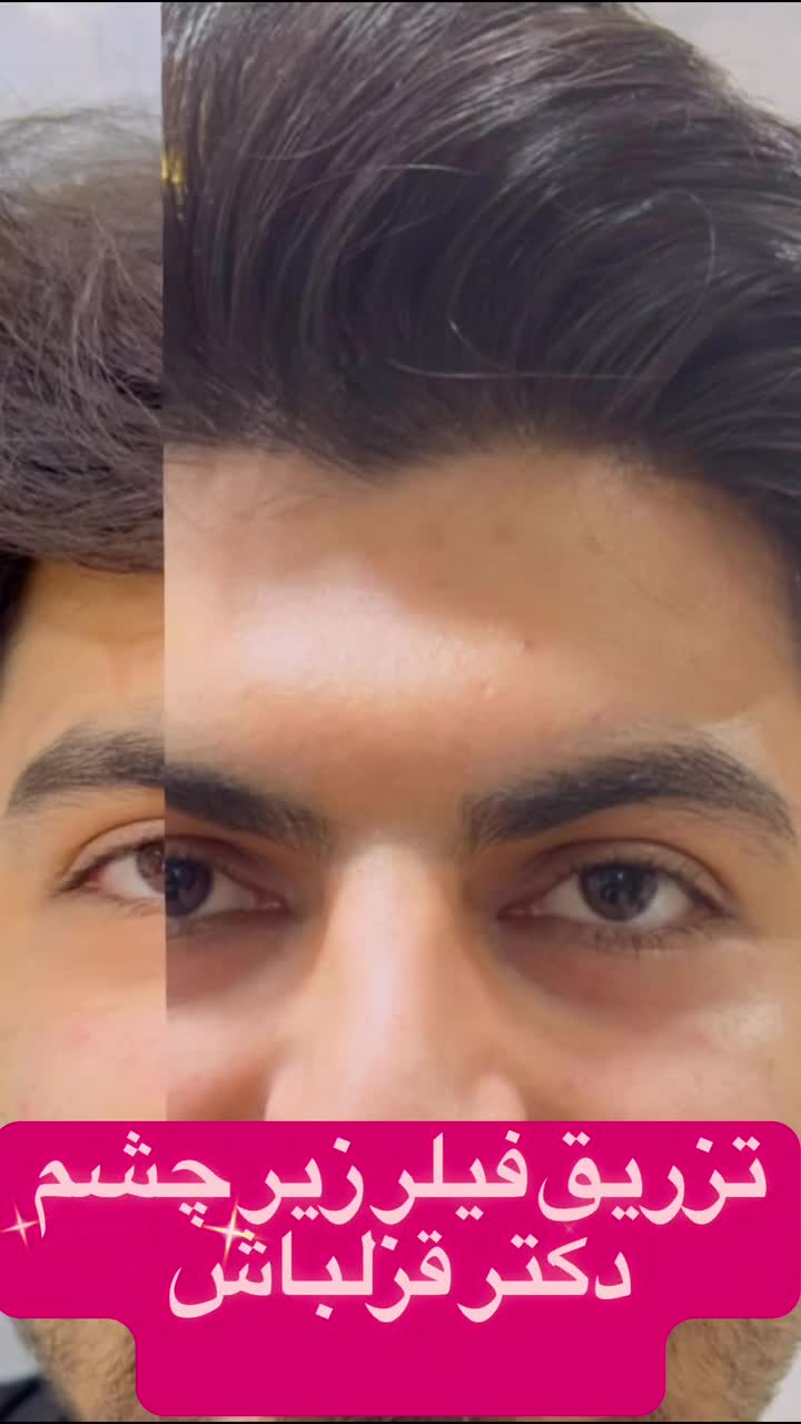 قبل و بعد فیلر زیر چشم؛ نتیجه را بدون معاینه تعمیم ندهید